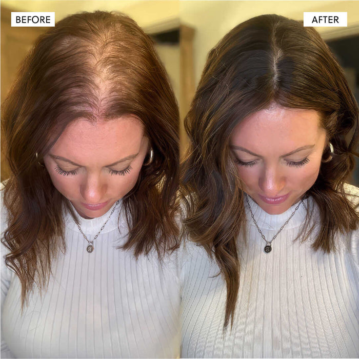 Side-by-side before and after hair restoration results.